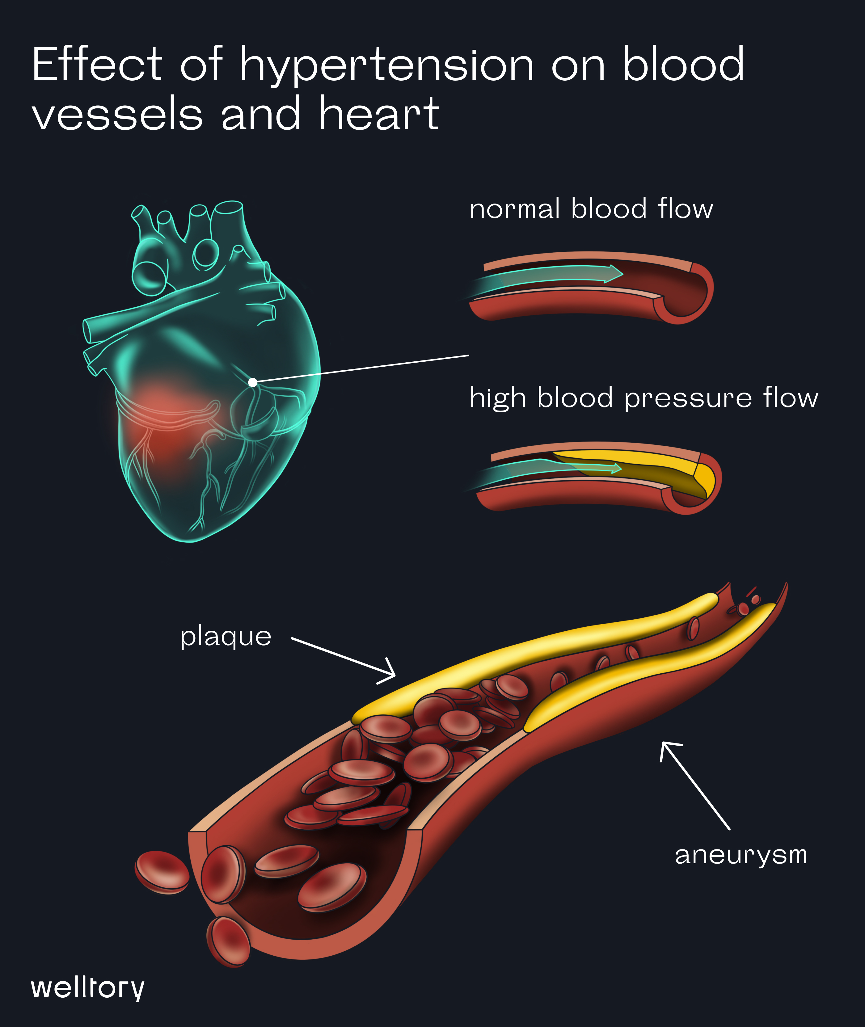 blood flow with hypertension, clogged blood vessel
